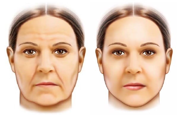 Lifting Facial, Ritidoplastia